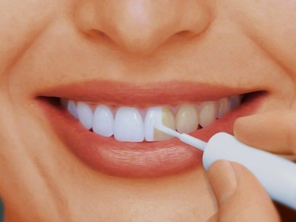 Отбеливание зубов дома. Что важно знать?